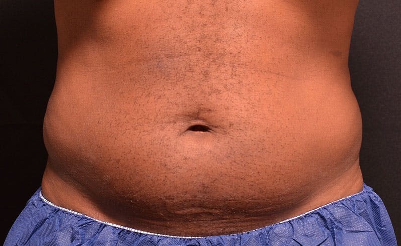 Male Abs Before & After Gallery - Patient 317770 - Image 1
