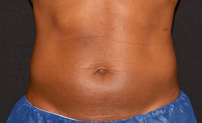 Male Abs Before & After Gallery - Patient 317770 - Image 2