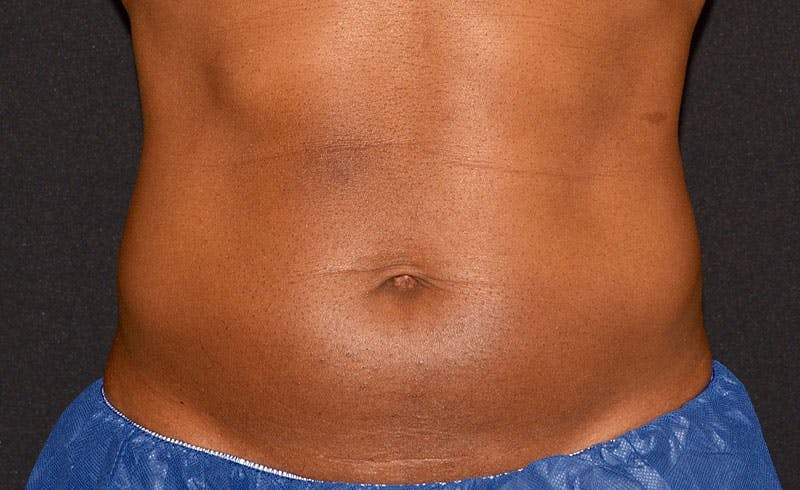 Male Abs Before & After Gallery - Patient 317770 - Image 2