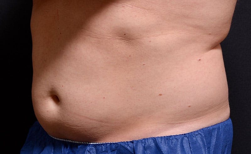 Male Abs Before & After Gallery - Patient 157210 - Image 1