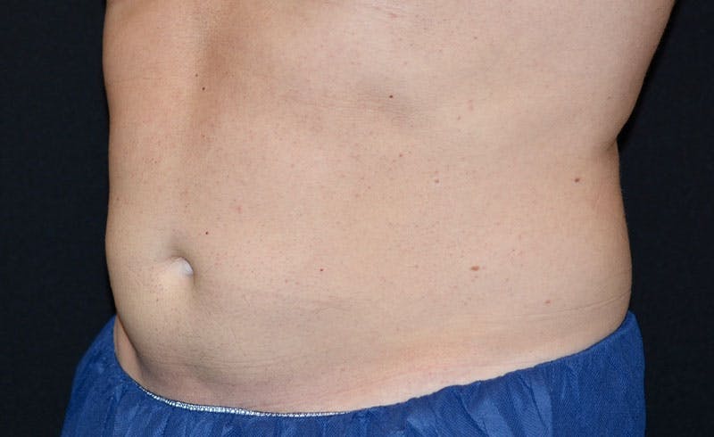 Male Abs Before & After Gallery - Patient 157210 - Image 2