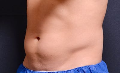 Male Abs Before & After Gallery - Patient 240106 - Image 1