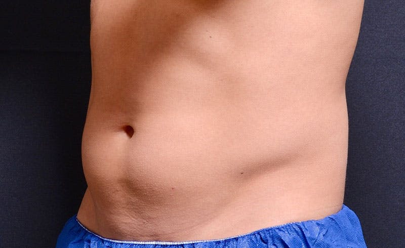 Male Abs Before & After Gallery - Patient 240106 - Image 1
