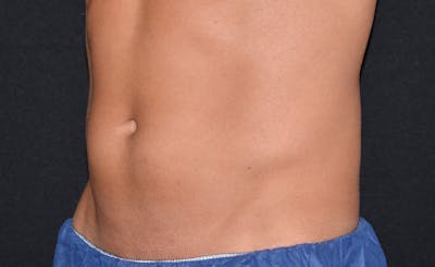 Male Abs Before & After Gallery - Patient 240106 - Image 2