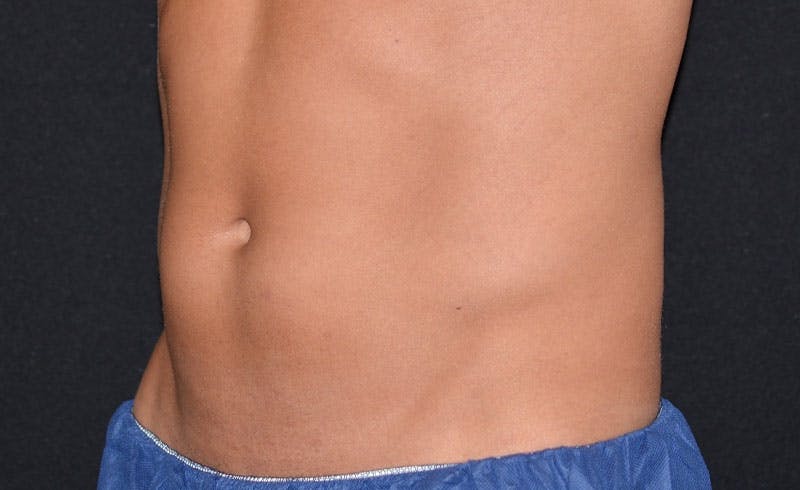 Male Abs Before & After Gallery - Patient 240106 - Image 2
