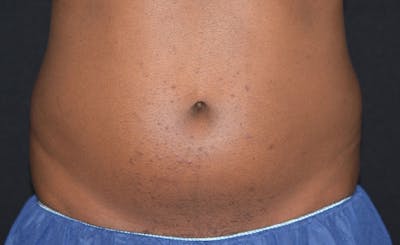 Male Abs Before & After Gallery - Patient 676162 - Image 1