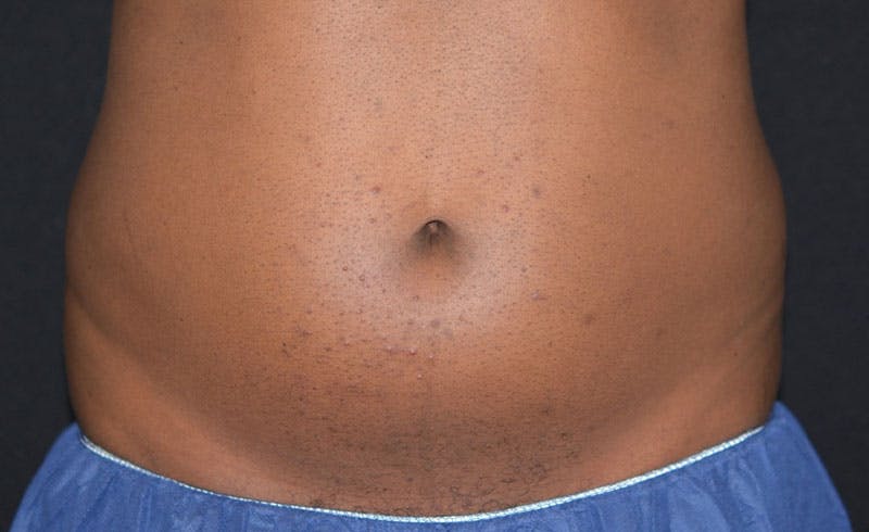 Male Abs Before & After Gallery - Patient 676162 - Image 1