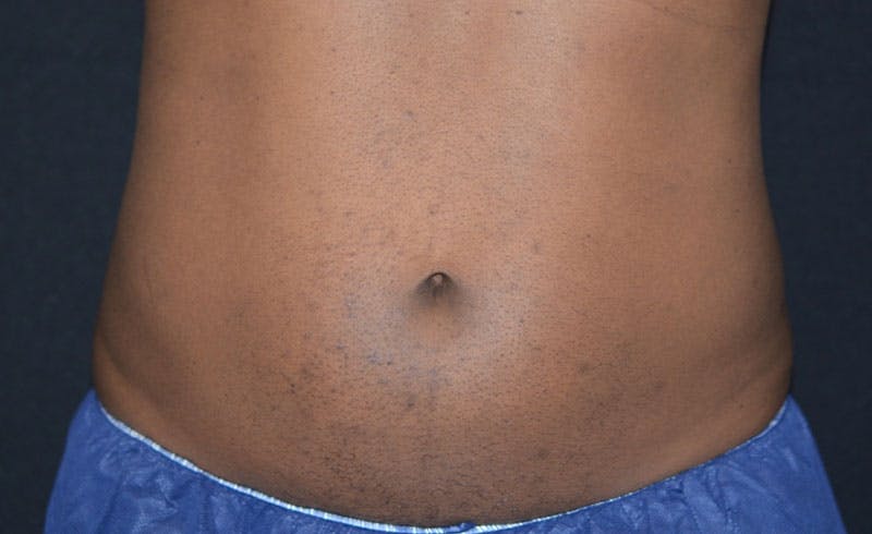 Male Abs Before & After Gallery - Patient 676162 - Image 2