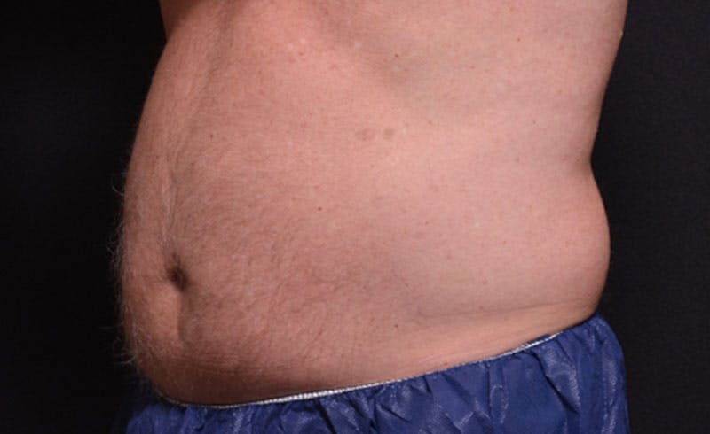 Male Abs Before & After Gallery - Patient 384540 - Image 1