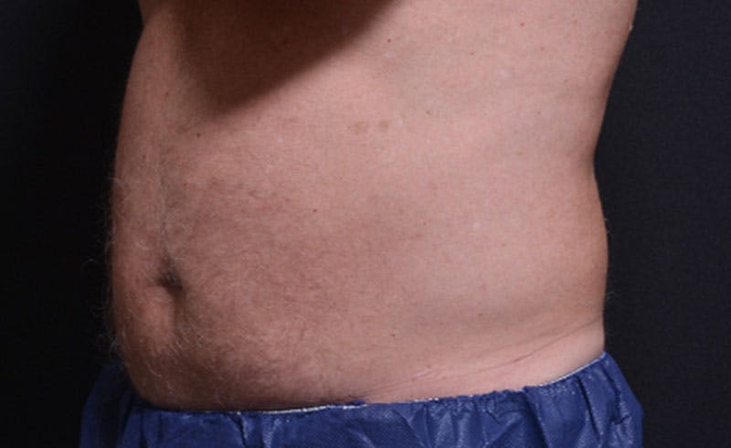 Male Abs Before & After Gallery - Patient 384540 - Image 2