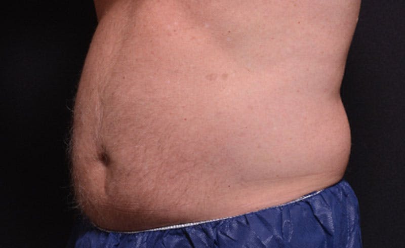 Male Abs Before & After Gallery - Patient 384540 - Image 3