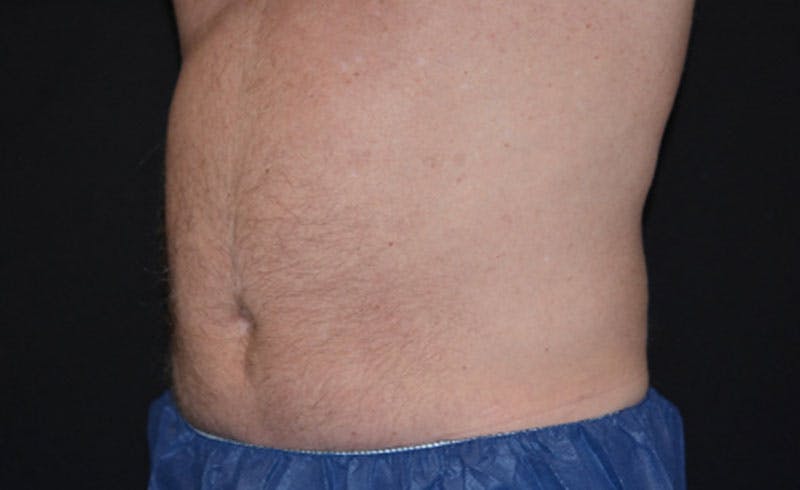 Male Abs Before & After Gallery - Patient 384540 - Image 4