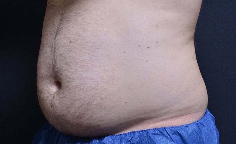 Male Abs Before & After Gallery - Patient 421524 - Image 1