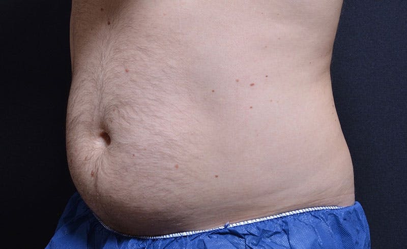 Male Abs Before & After Gallery - Patient 421524 - Image 2