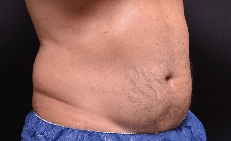 Male Abs Before & After Gallery - Patient 373449 - Image 1