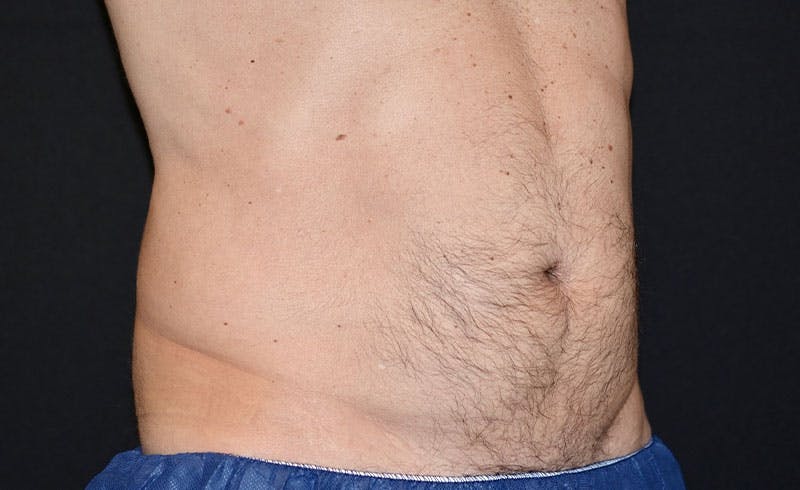 Male Abs Before & After Gallery - Patient 373449 - Image 2
