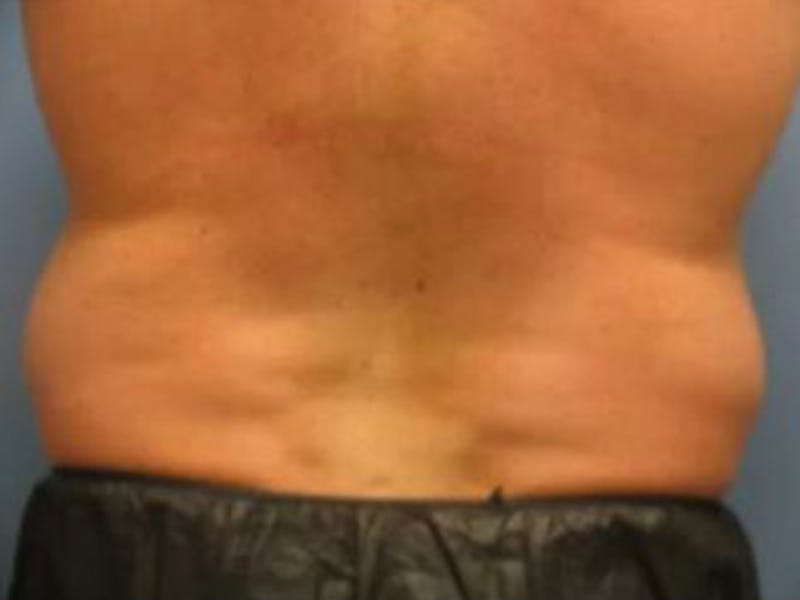 Male Love Handles Before & After Gallery - Patient 177586 - Image 1