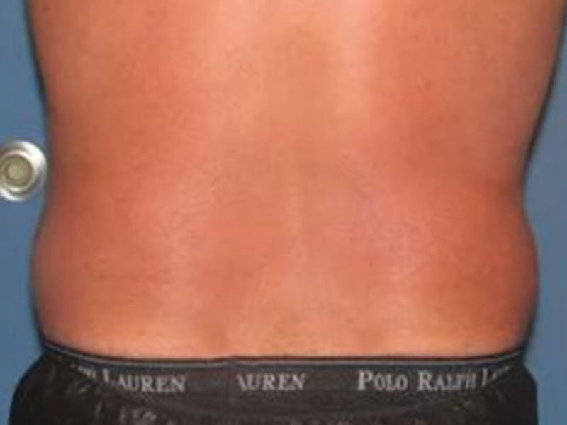Male Love Handles Before & After Gallery - Patient 177586 - Image 2