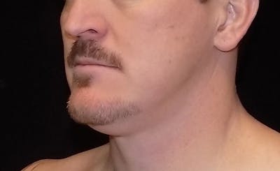 Male Double Chin Before & After Gallery - Patient 155746 - Image 1