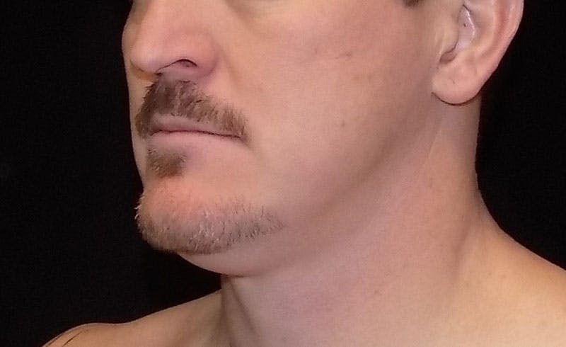 Male Double Chin Before & After Gallery - Patient 155746 - Image 1