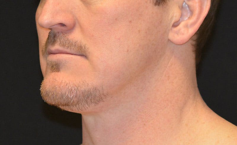 Male Double Chin Before & After Gallery - Patient 155746 - Image 2