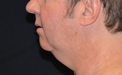Male Double Chin Before & After Gallery - Patient 209331 - Image 1