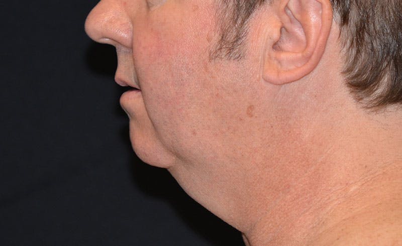 Male Double Chin Before & After Gallery - Patient 209331 - Image 1