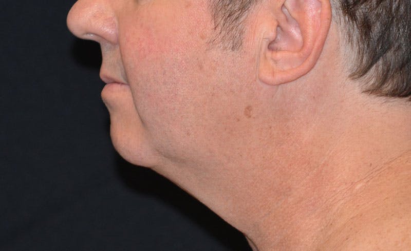 Male Double Chin Before & After Gallery - Patient 209331 - Image 2