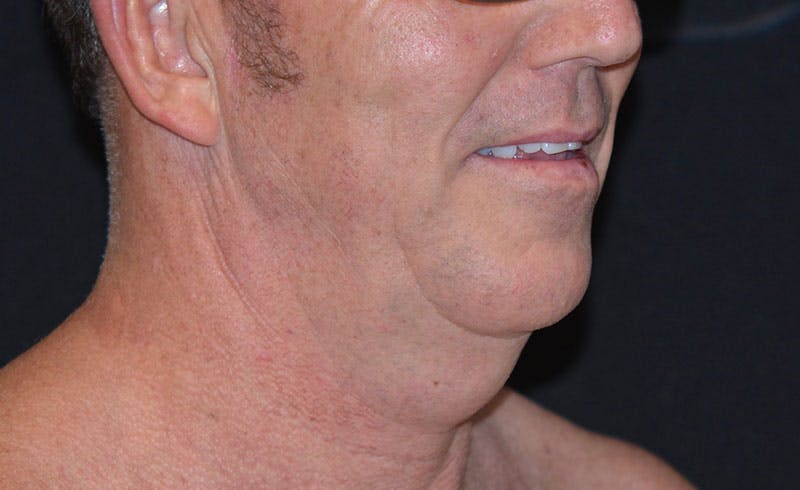 Male Double Chin Before & After Gallery - Patient 368528 - Image 1