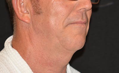 Male Double Chin Before & After Gallery - Patient 368528 - Image 2