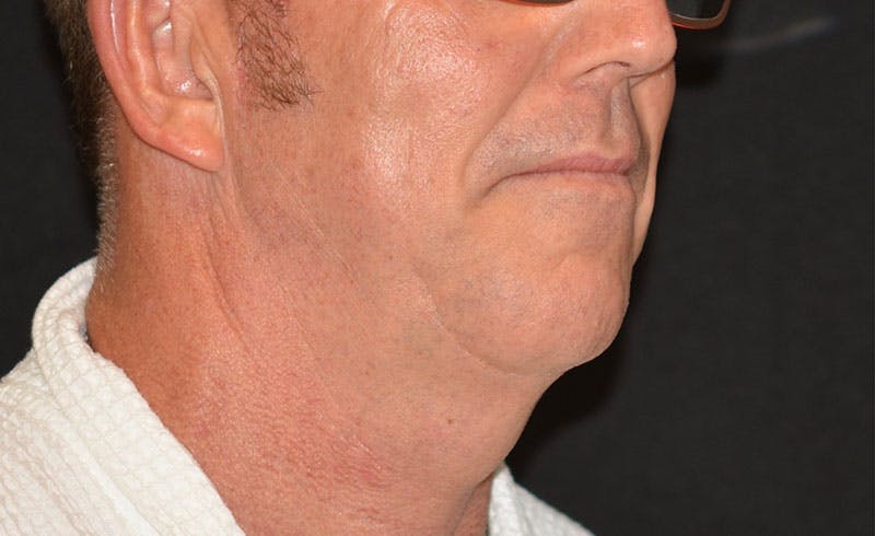 Male Double Chin Before & After Gallery - Patient 368528 - Image 2
