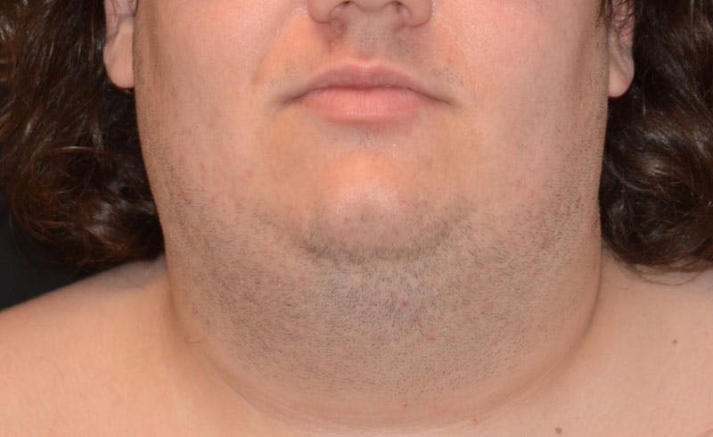 Male Double Chin Before & After Gallery - Patient 365225 - Image 1