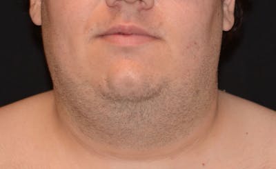 Male Double Chin Before & After Gallery - Patient 365225 - Image 2
