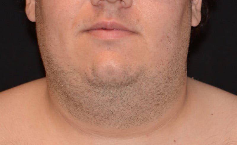 Male Double Chin Before & After Gallery - Patient 365225 - Image 2