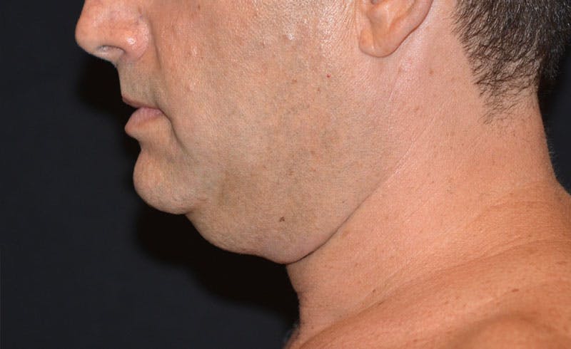 Male Double Chin Before & After Gallery - Patient 170911 - Image 1