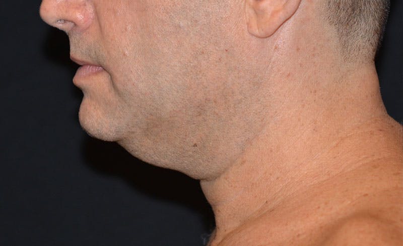 Male Double Chin Before & After Gallery - Patient 170911 - Image 2