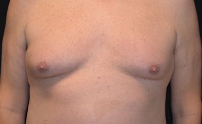 Male Pecs Before & After Gallery - Patient 303116 - Image 1