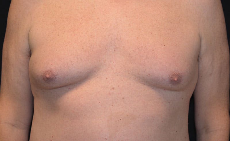 Male Pecs Before & After Gallery - Patient 303116 - Image 1