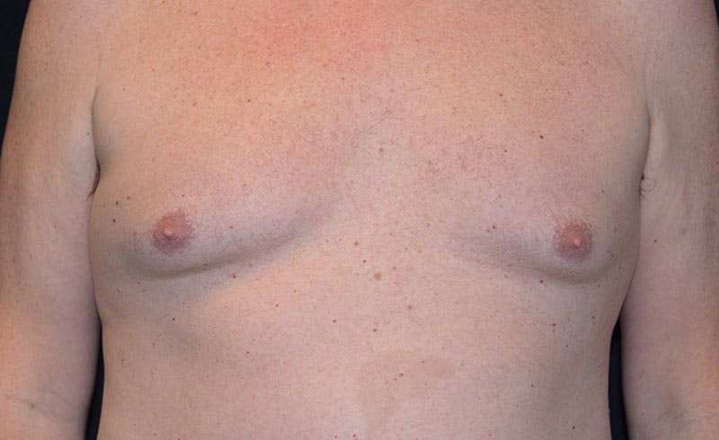 Male Pecs Before & After Gallery - Patient 303116 - Image 2