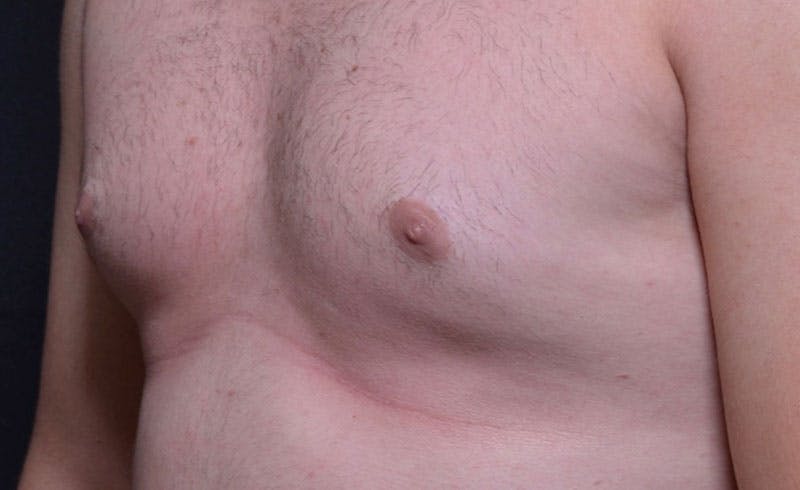 Male Pecs Before & After Gallery - Patient 105323 - Image 1