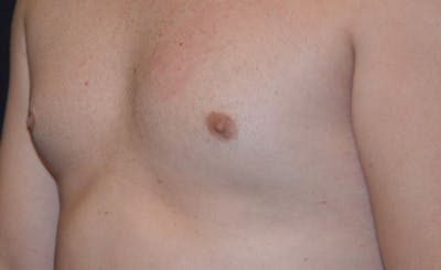 Male Pecs Before & After Gallery - Patient 105323 - Image 2