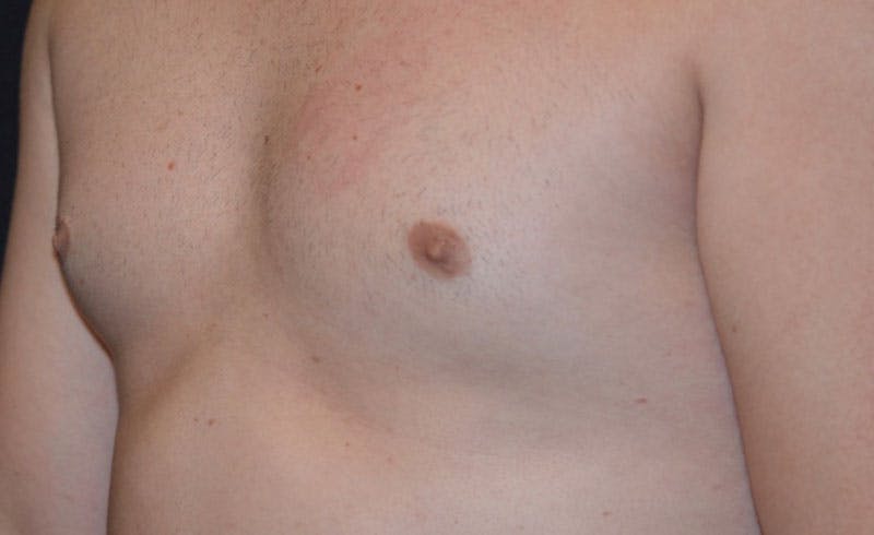 Male Pecs Before & After Gallery - Patient 105323 - Image 2