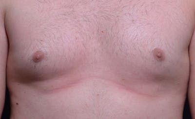 Male Pecs Before & After Gallery - Patient 322398 - Image 1