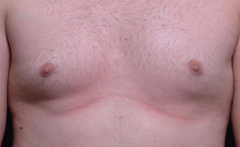 Male Pecs Before & After Gallery - Patient 322398 - Image 1
