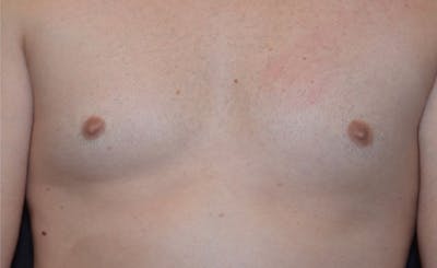 Male Pecs Before & After Gallery - Patient 322398 - Image 2