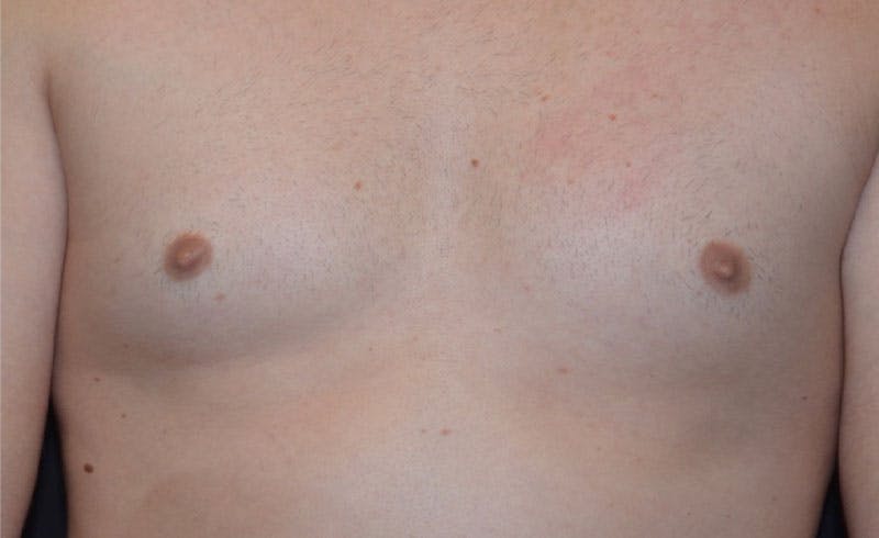 Male Pecs Before & After Gallery - Patient 322398 - Image 2