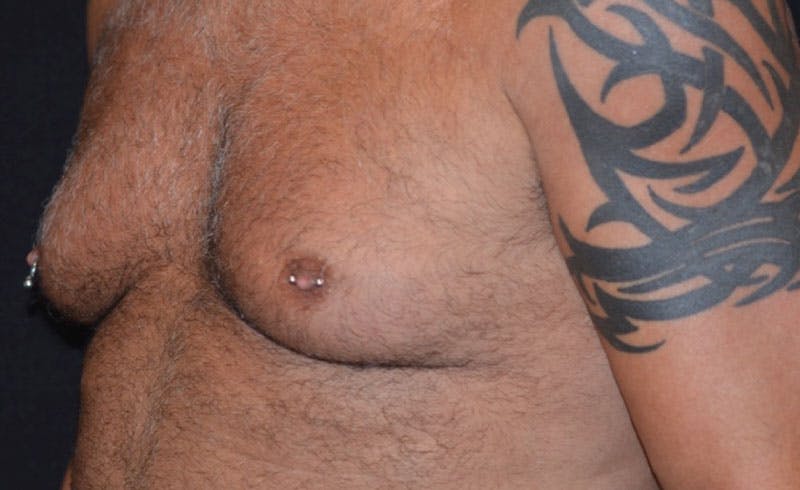 Male Pecs Before & After Gallery - Patient 426120 - Image 1