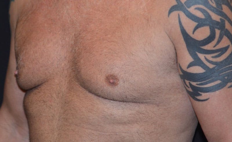Male Pecs Before & After Gallery - Patient 426120 - Image 2