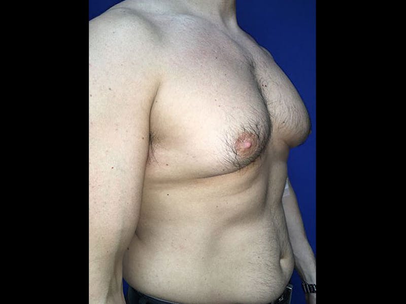 Male Pecs Before & After Gallery - Patient 185107 - Image 1