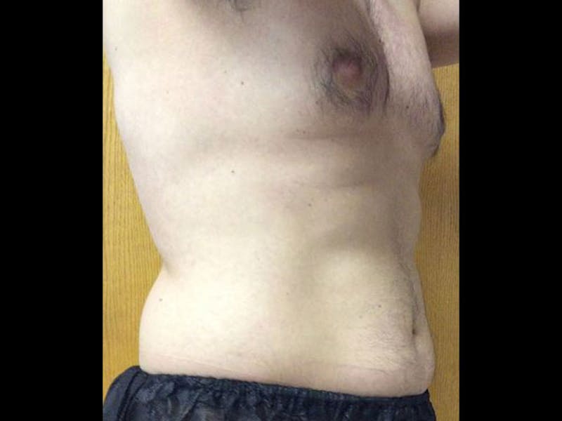 Male Pecs Before & After Gallery - Patient 185107 - Image 2